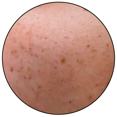 skin with hyperpigmentation